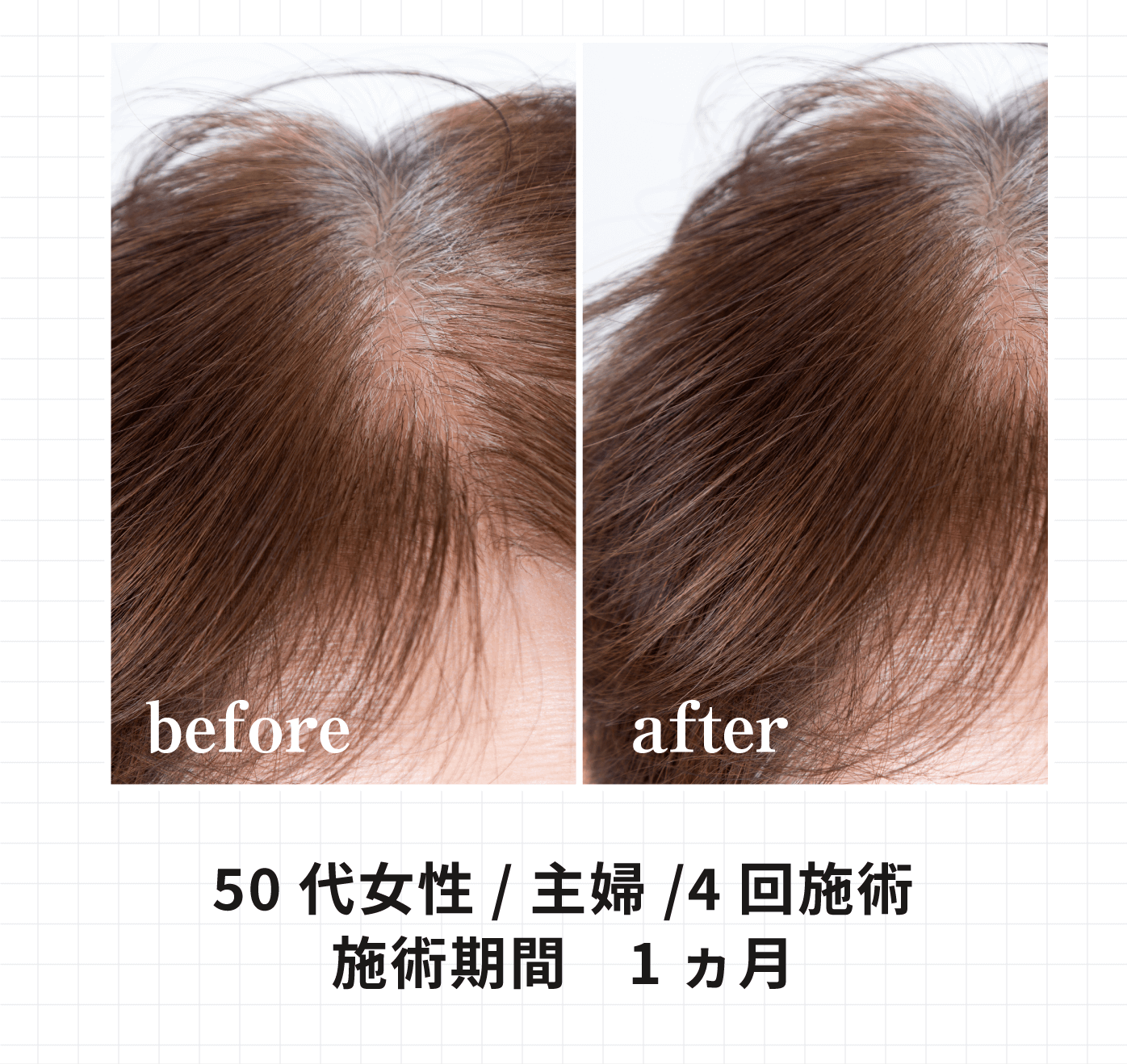 50代女性 主婦 4回施術 施術期間 1ヶ月