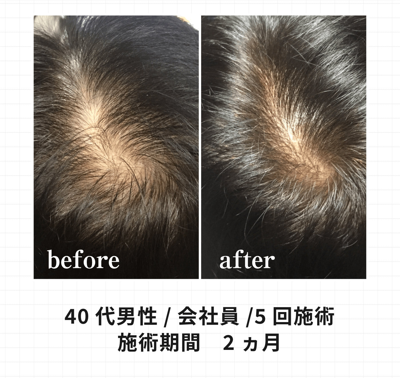 40代男性 会社員 5回施術 施術期間 2ヶ月