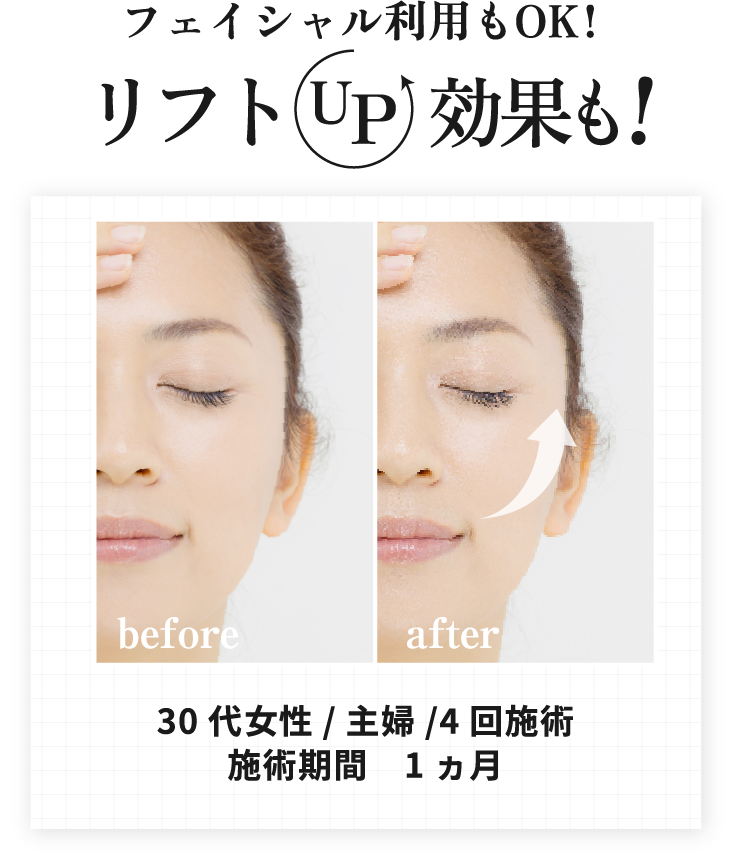 フェイシャル利用もOK! リフトUP効果も!